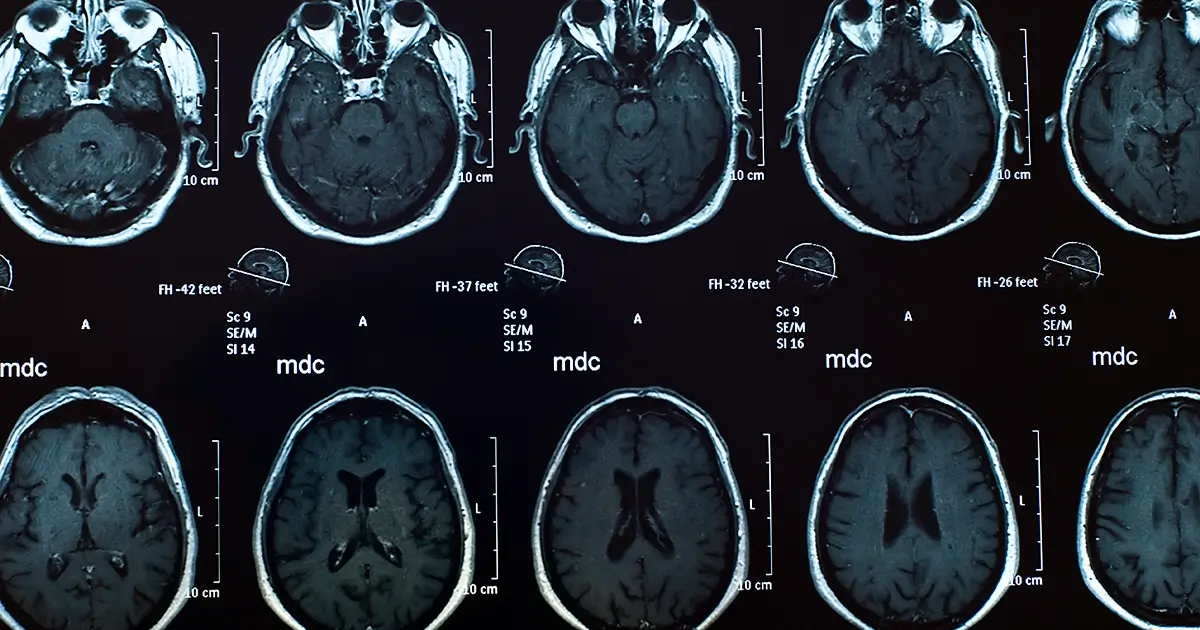 Fort Lauderdale Brain Injury Lawyer